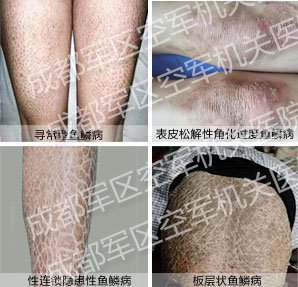 鱼鳞病 治疗 > 鱼鳞病的治疗及保养    鱼鳞病,俗称"鱼鳞癣","蛇皮癣"
